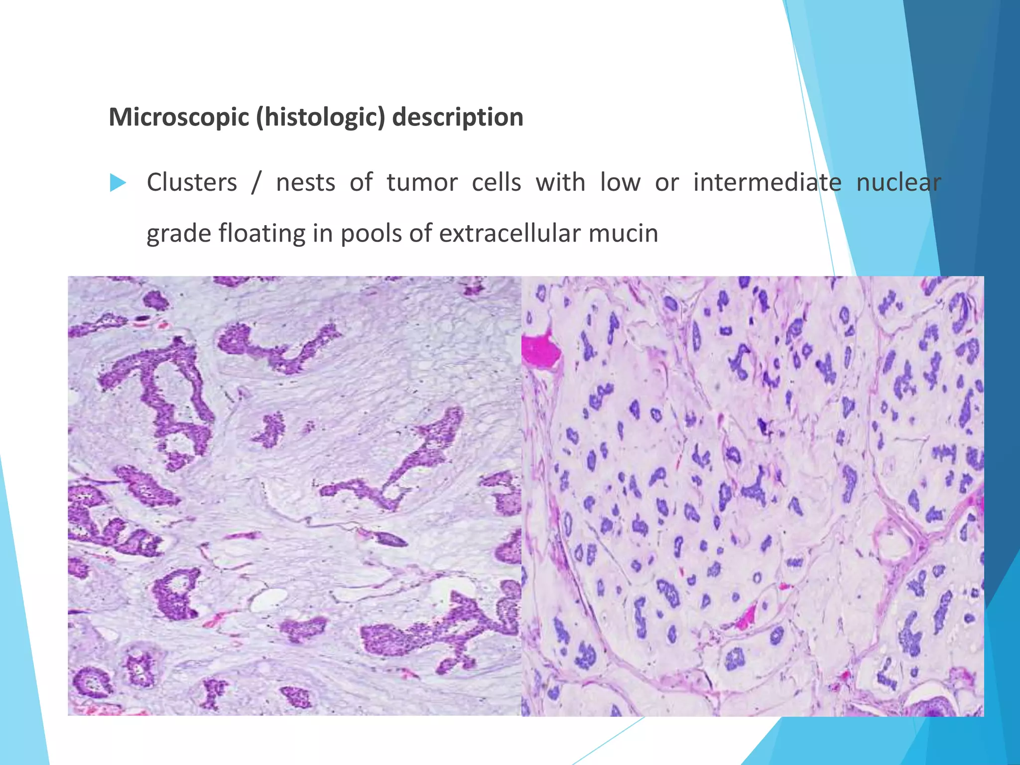 Microscopic (histologic) description
 Clusters / nests of tumor cells with low or intermediate nuclear
grade floating in pools of extracellular mucin
 