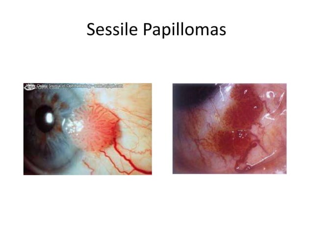 Diseases Of Conjunctiva pptx diseases-of-conjunctiva-pptx