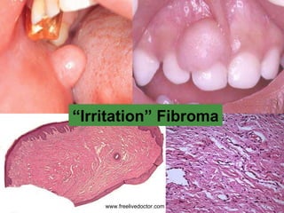 “ Irritation” Fibroma www.freelivedoctor.com 
