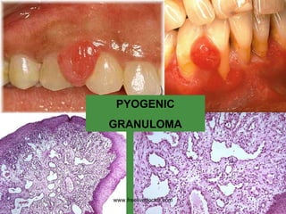 PYOGENIC GRANULOMA www.freelivedoctor.com 