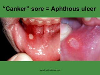 “ Canker” sore = Aphthous ulcer www.freelivedoctor.com 
