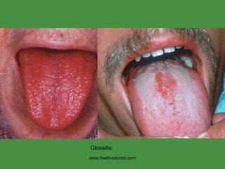 www.freelivedoctor.com Glossitis: 