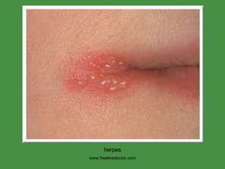 www.freelivedoctor.com herpes 