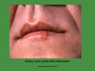 www.freelivedoctor.com Herpes, dried vesicle with inflammation 