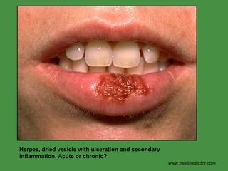 www.freelivedoctor.com Herpes, dried vesicle with ulceration and secondary inflammation. Acute or chronic? 