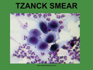 TZANCK SMEAR www.freelivedoctor.com 