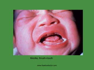 www.freelivedoctor.com Monilia, thrush-mouth  