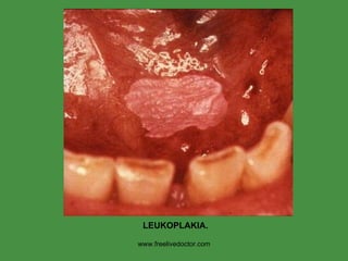 www.freelivedoctor.com LEUKOPLAKIA. 