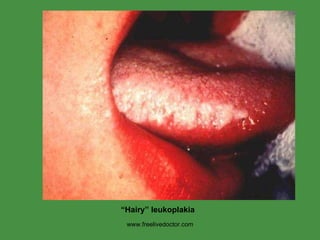 www.freelivedoctor.com “ Hairy” leukoplakia  