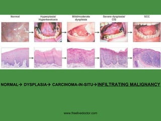 NORMAL   DYSPLASIA   CARCINOMA-IN-SITU  INFILTRATING MALIGNANCY www.freelivedoctor.com 