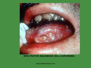 www.freelivedoctor.com INFILTRATIVE   SQUAMOUS CELL CARCINOMA  