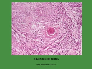 www.freelivedoctor.com squamous cell cancer,  