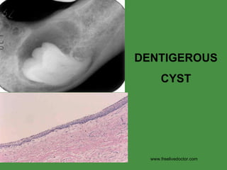 DENTIGEROUS CYST www.freelivedoctor.com 