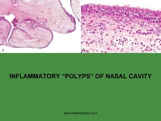 INFLAMMATORY “POLYPS” OF NASAL CAVITY www.freelivedoctor.com 