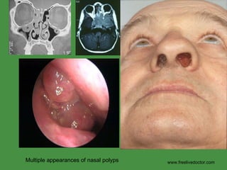 www.freelivedoctor.com Multiple appearances of nasal polyps 