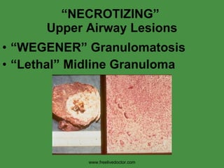 “ NECROTIZING”  Upper Airway Lesions “ WEGENER” Granulomatosis “ Lethal” Midline Granuloma www.freelivedoctor.com 