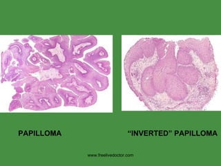 PAPILLOMA   “INVERTED” PAPILLOMA www.freelivedoctor.com 