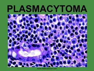 PLASMACYTOMA www.freelivedoctor.com 