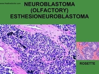 NEUROBLASTOMA (OLFACTORY) ESTHESIONEUROBLASTOMA ROSETTE www.freelivedoctor.com 
