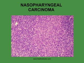 NASOPHARYNGEAL CARCINOMA www.freelivedoctor.com 