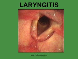 LARYNGITIS www.freelivedoctor.com 