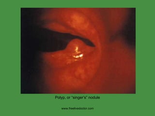 www.freelivedoctor.com Polyp, or “singer’s” nodule 