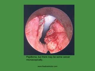 www.freelivedoctor.com Papilloma, but there may be some cancer microscopically. 