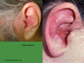 www.freelivedoctor.com Otitis externa 