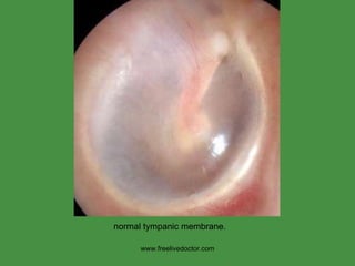 www.freelivedoctor.com normal tympanic membrane. 
