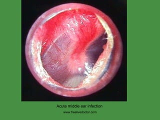 www.freelivedoctor.com Acute middle ear infection 