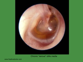 www.freelivedoctor.com Chronic “serous” otitis media 