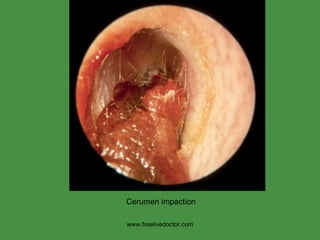 www.freelivedoctor.com Cerumen impaction 