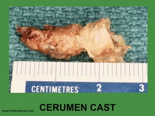 CERUMEN CAST www.freelivedoctor.com 