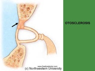 OTOSCLEROSIS www.freelivedoctor.com 