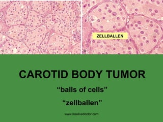 CAROTID BODY TUMOR “ balls of cells” “ zellballen” ZELLBALLEN www.freelivedoctor.com 