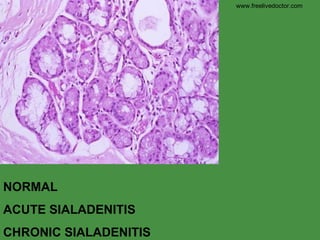 NORMAL ACUTE SIALADENITIS CHRONIC SIALADENITIS www.freelivedoctor.com 