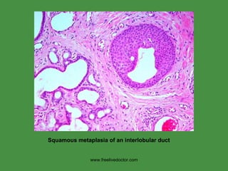 www.freelivedoctor.com Squamous metaplasia of an interlobular duct  