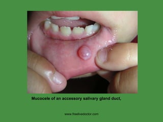 www.freelivedoctor.com Mucocele of an accessory salivary gland duct,  