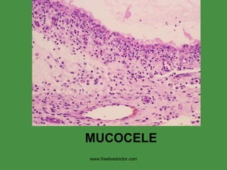MUCOCELE www.freelivedoctor.com 
