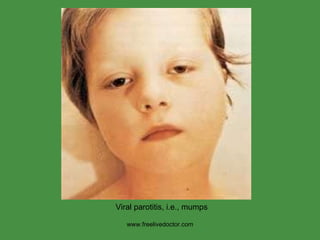www.freelivedoctor.com Viral parotitis, i.e., mumps 