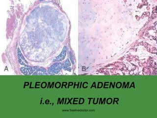 PLEOMORPHIC ADENOMA i.e., MIXED TUMOR www.freelivedoctor.com 