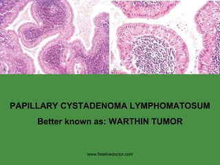 PAPILLARY CYSTADENOMA LYMPHOMATOSUM Better known as: WARTHIN TUMOR www.freelivedoctor.com 