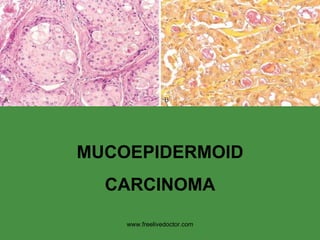 MUCOEPIDERMOID CARCINOMA www.freelivedoctor.com 