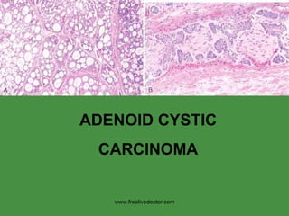 ADENOID CYSTIC CARCINOMA www.freelivedoctor.com 