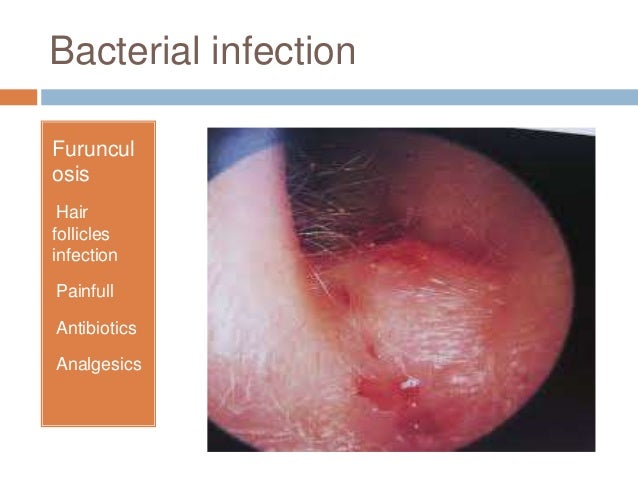 Diseases of external ear