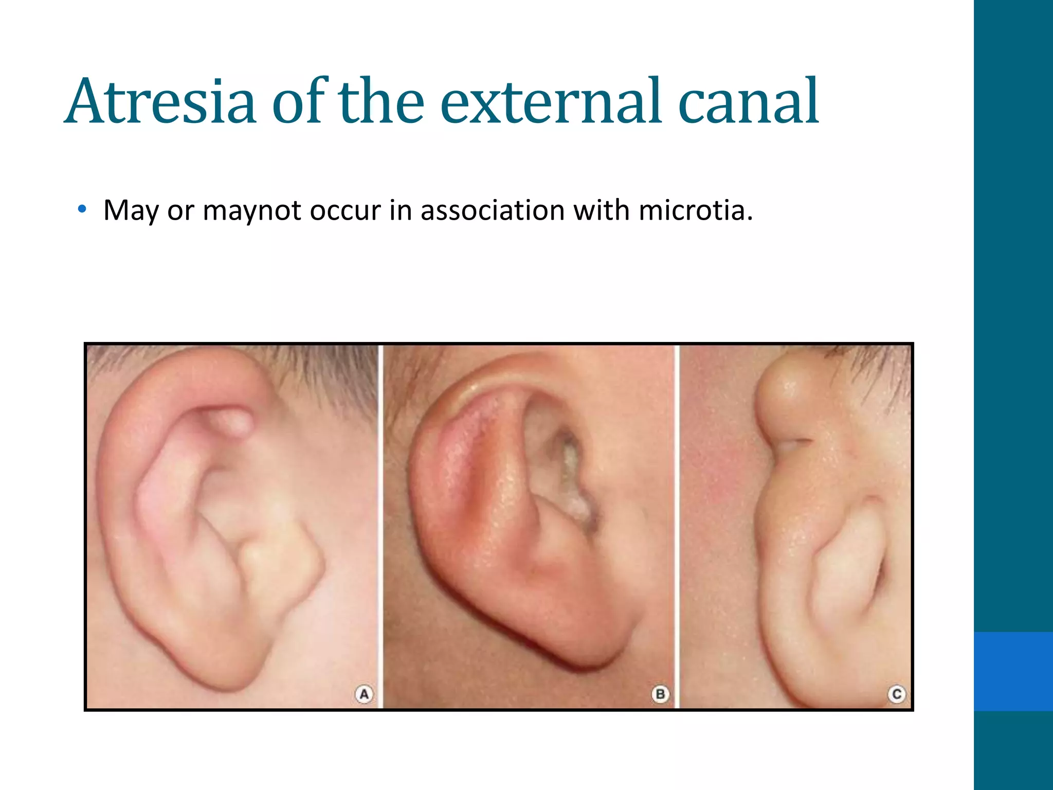 Diseases of external ear | PPTX