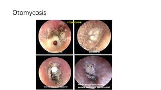 diseasesofexternalear | PPTX