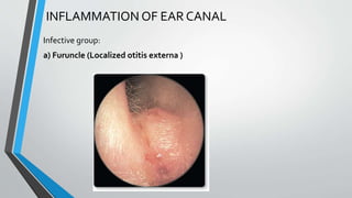 Diseases of External Ear.pptx