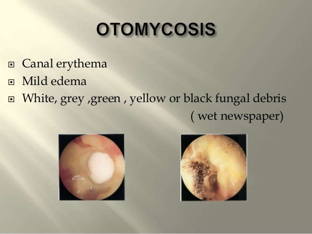 Diseases Of External Eardrsgopalakrishnan 130617