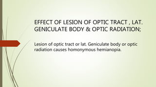 EFFECT OF LESION OF OPTIC TRACT , LAT.
GENICULATE BODY & OPTIC RADIATION;
Lesion of optic tract or lat. Geniculate body or optic
radiation causes homonymous hemianopia.
 